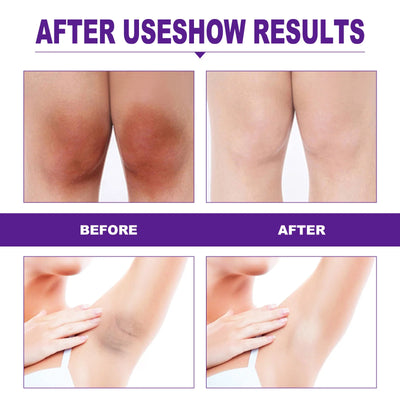 Women Skin Whitening Cream Remove Melanin Emulsion Brighten Inner Thigh Whiten Butt Knee  Private Parts Underarm Bleaching Serum